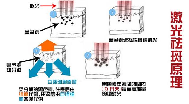 染料-染料激光